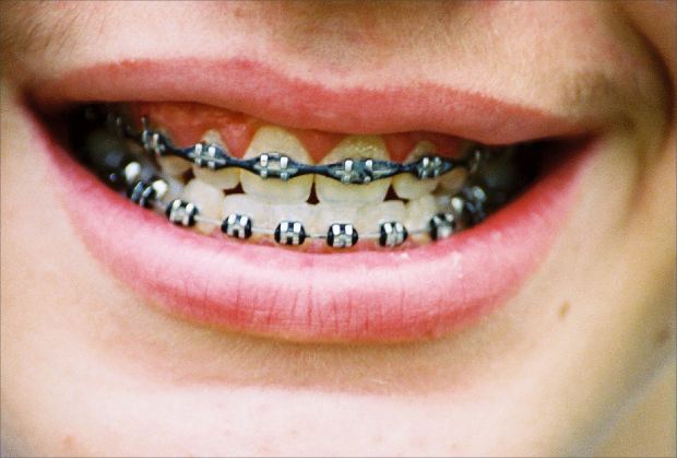 Invisalign: The New Alternative To Braces! 