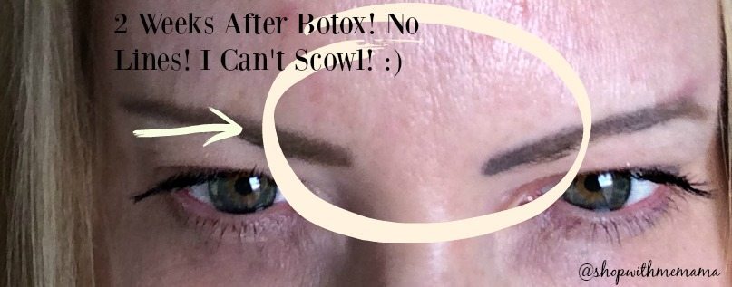 Botox Before And After Pictures