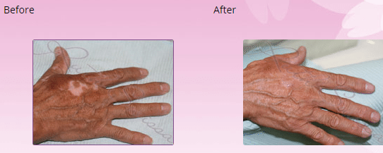 Reconstructive Pigmentation before and after pictures