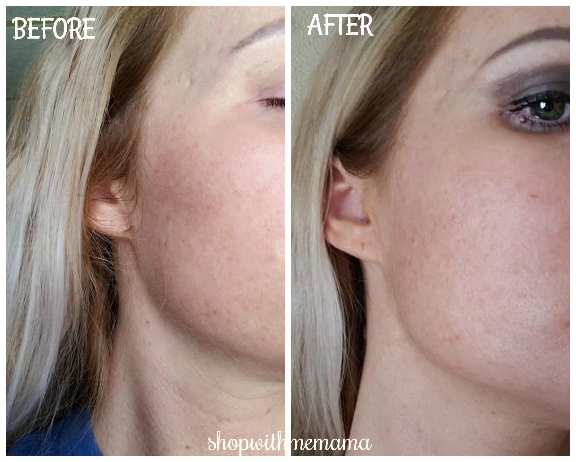 Before and after pictures of skin