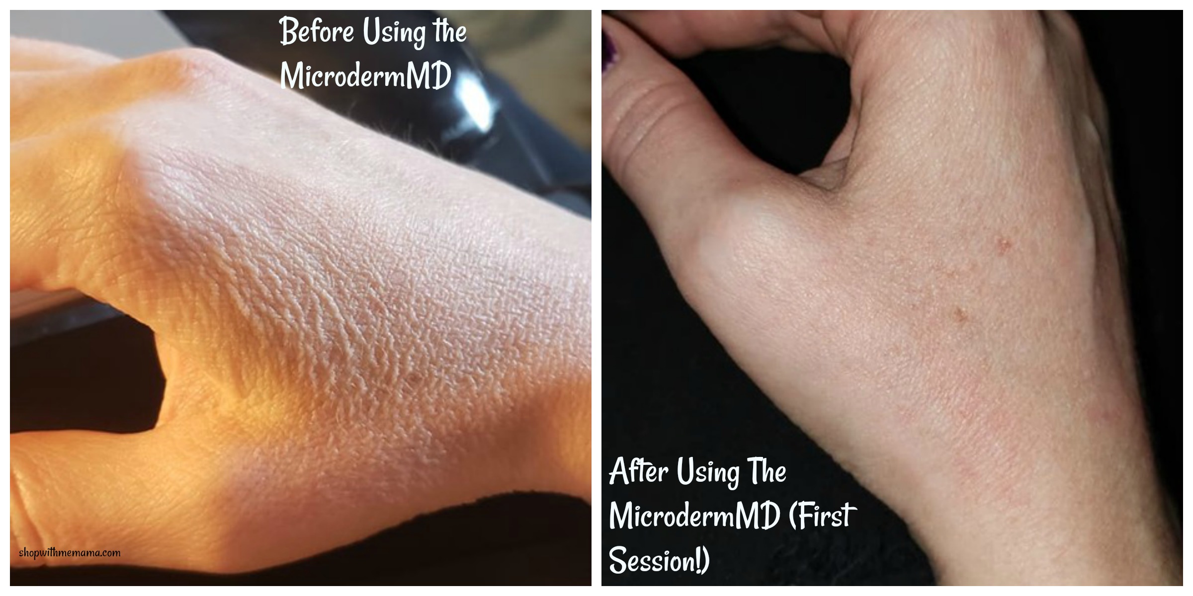 Trophy Skin RejuvaliteMD Before and After Photos