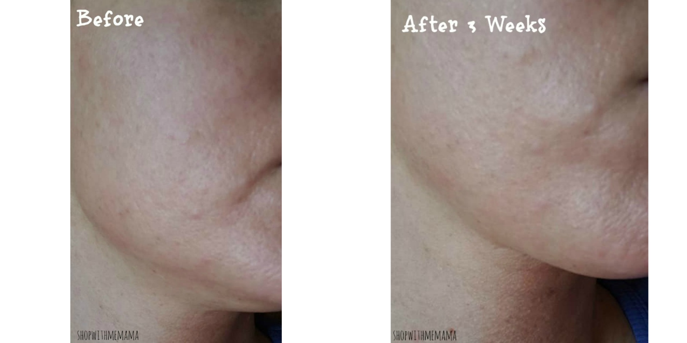 Skincare Laser before and after photos