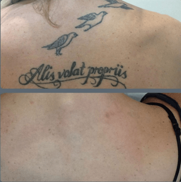 Is Laser Tattoo Removal Worth The Cost