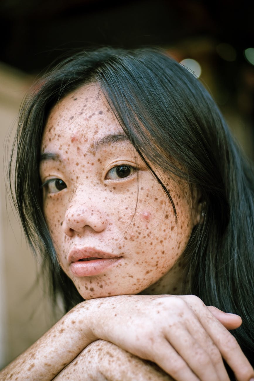 freckles