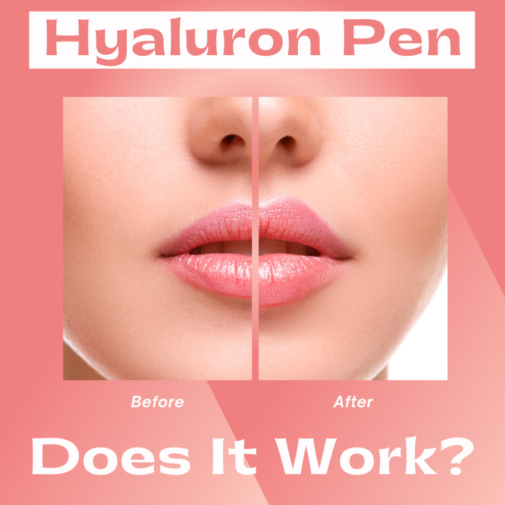 I Tried The Hyaluron Pen And This Is What Happened... 2023