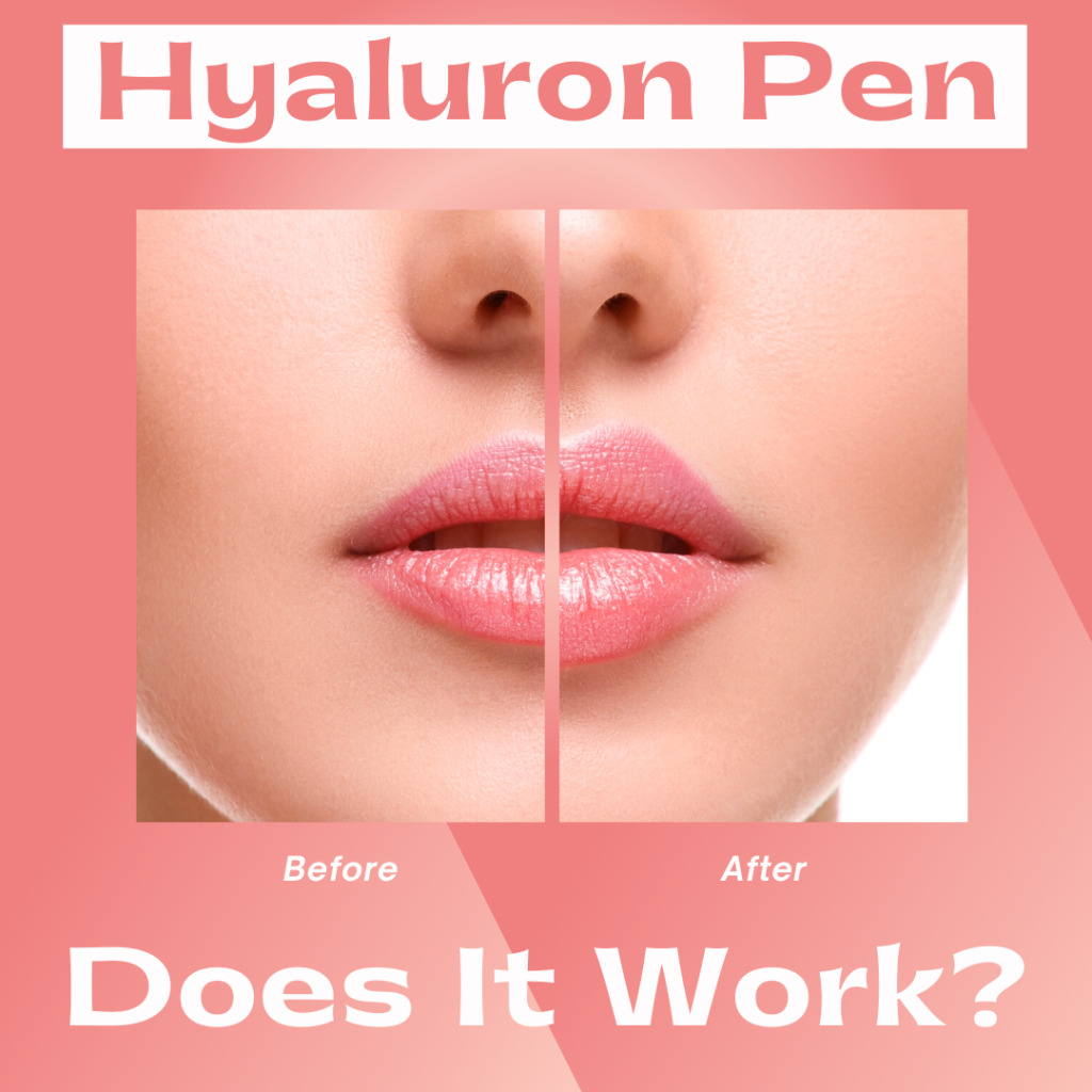 I Tried The Hyaluron Pen And This Is What Happened… 2023 - Shop With