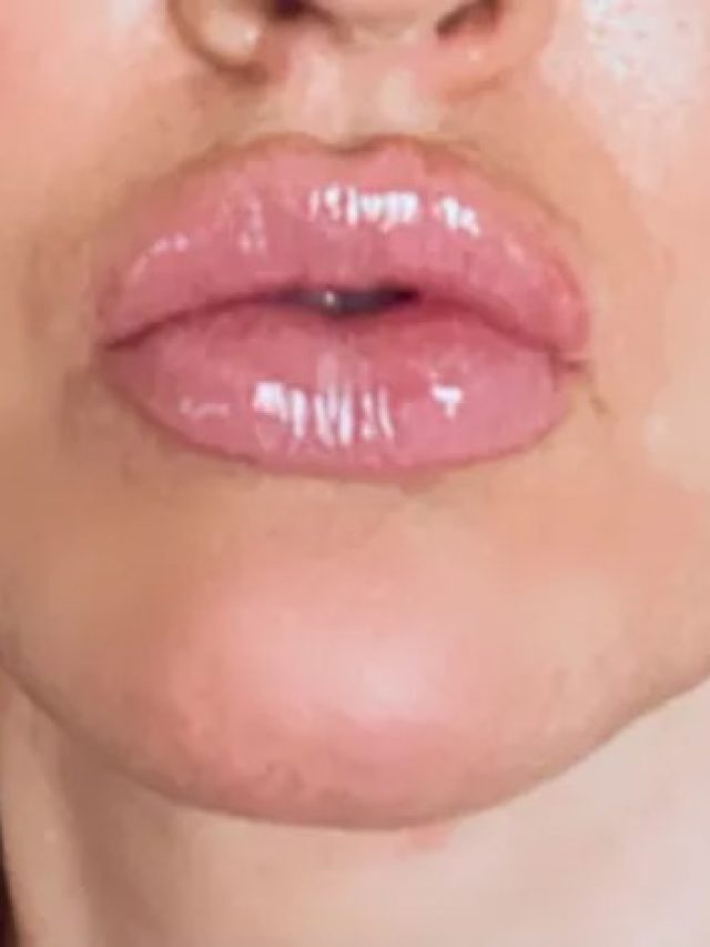 Want Plumper Lips? Here Is Why You Should Try the Hyaluron Pen