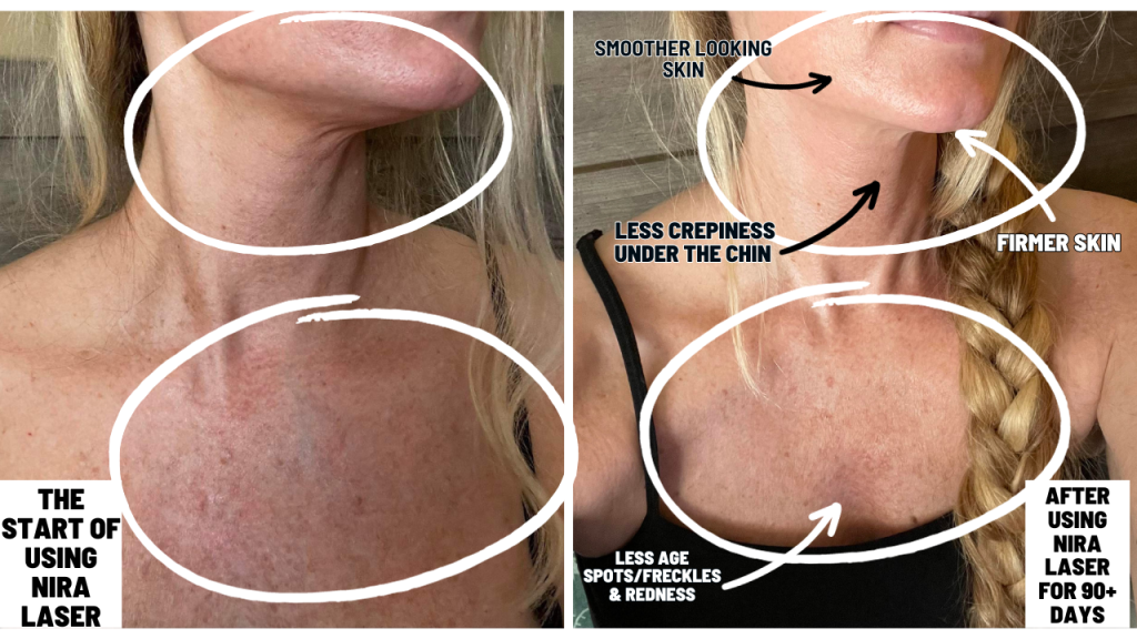 My NIRA Laser Results: Before And After Pictures!