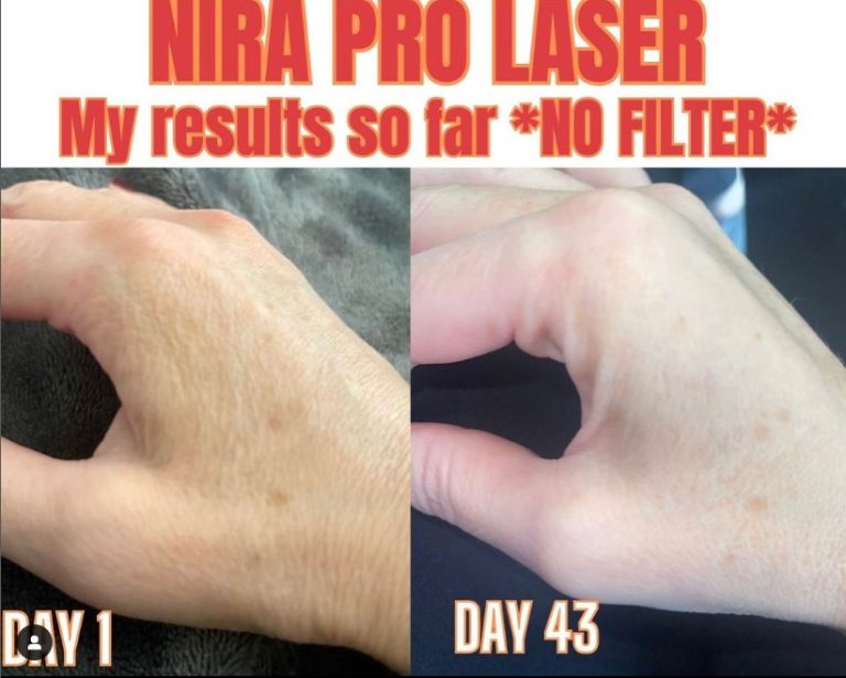 My NIRA Pro Laser Results Before And After Pictures! (+20 Off Code