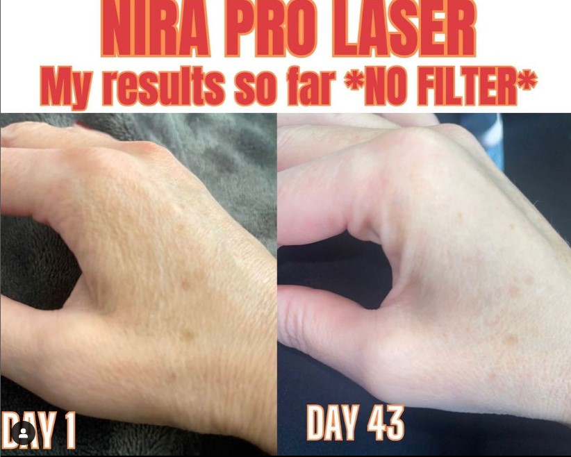 My NIRA Laser Results: Before And After Pictures!
