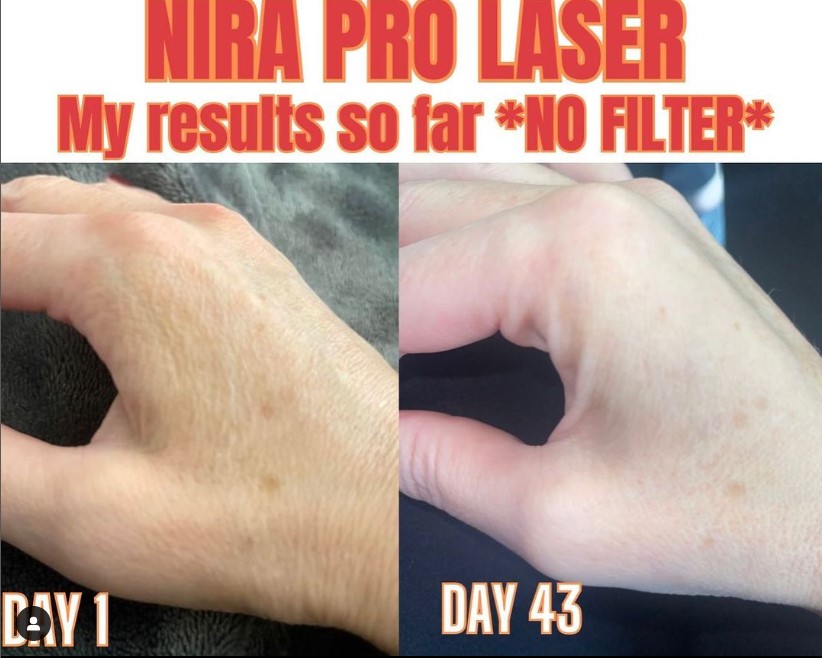 My Nira Pro Laser Results Before And After Pictures 20 Off Code Shop With Me Mama