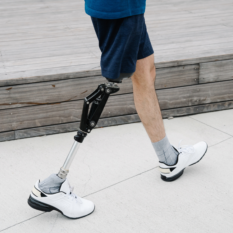 You Ain't Done Running Yet: Getting Leg Prosthetics