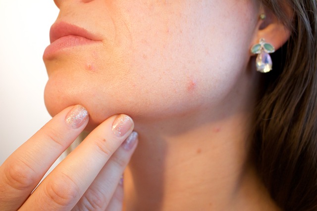 Solve Your Acne Problems: A How-To Guide