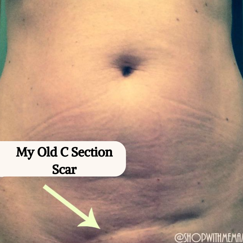 Products That Make Scars Less Noticeable